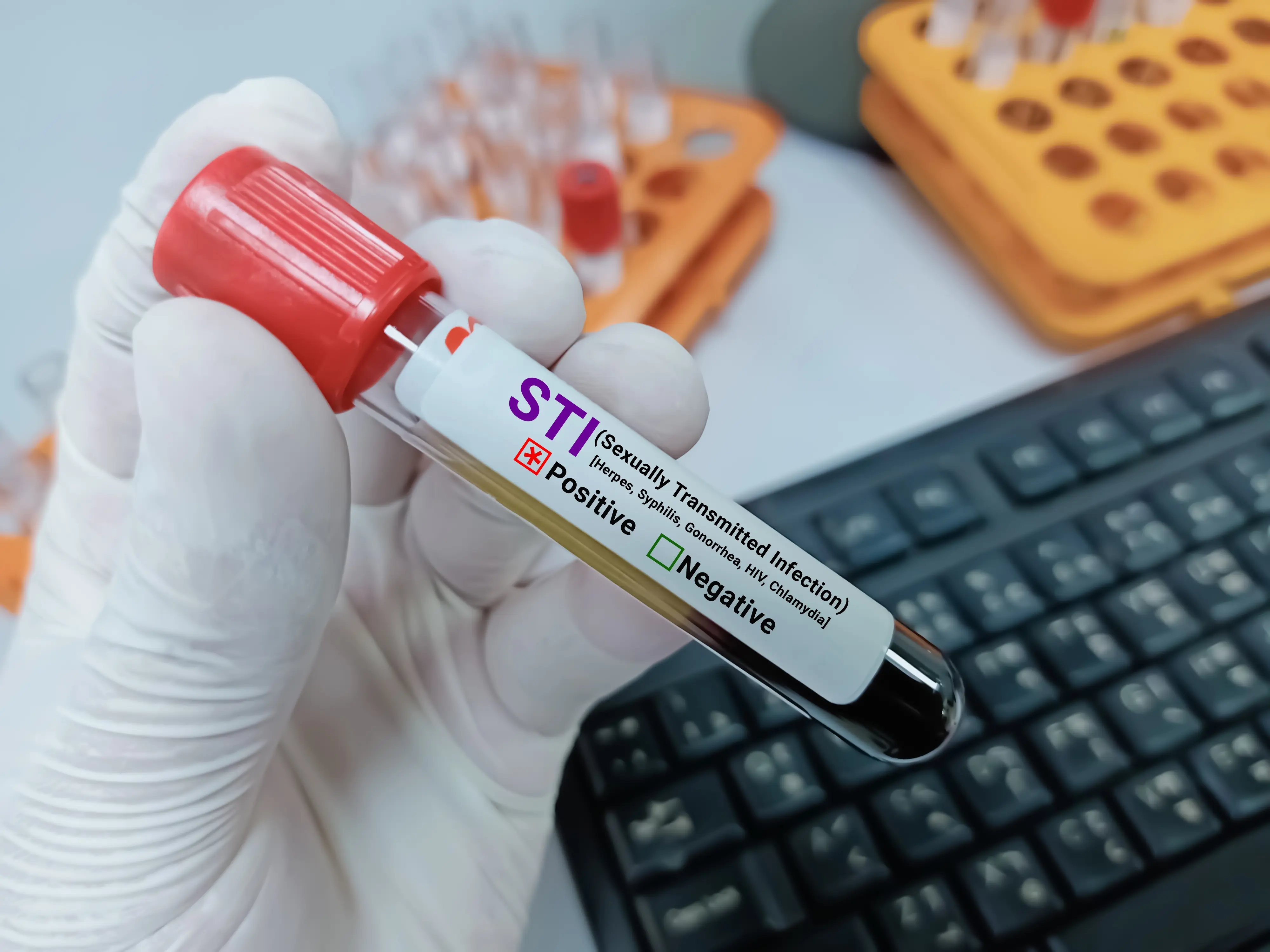 Doctor,Hold,Blood,Sample,For,Sti,(sexually,Transmitted,Infection),Test.