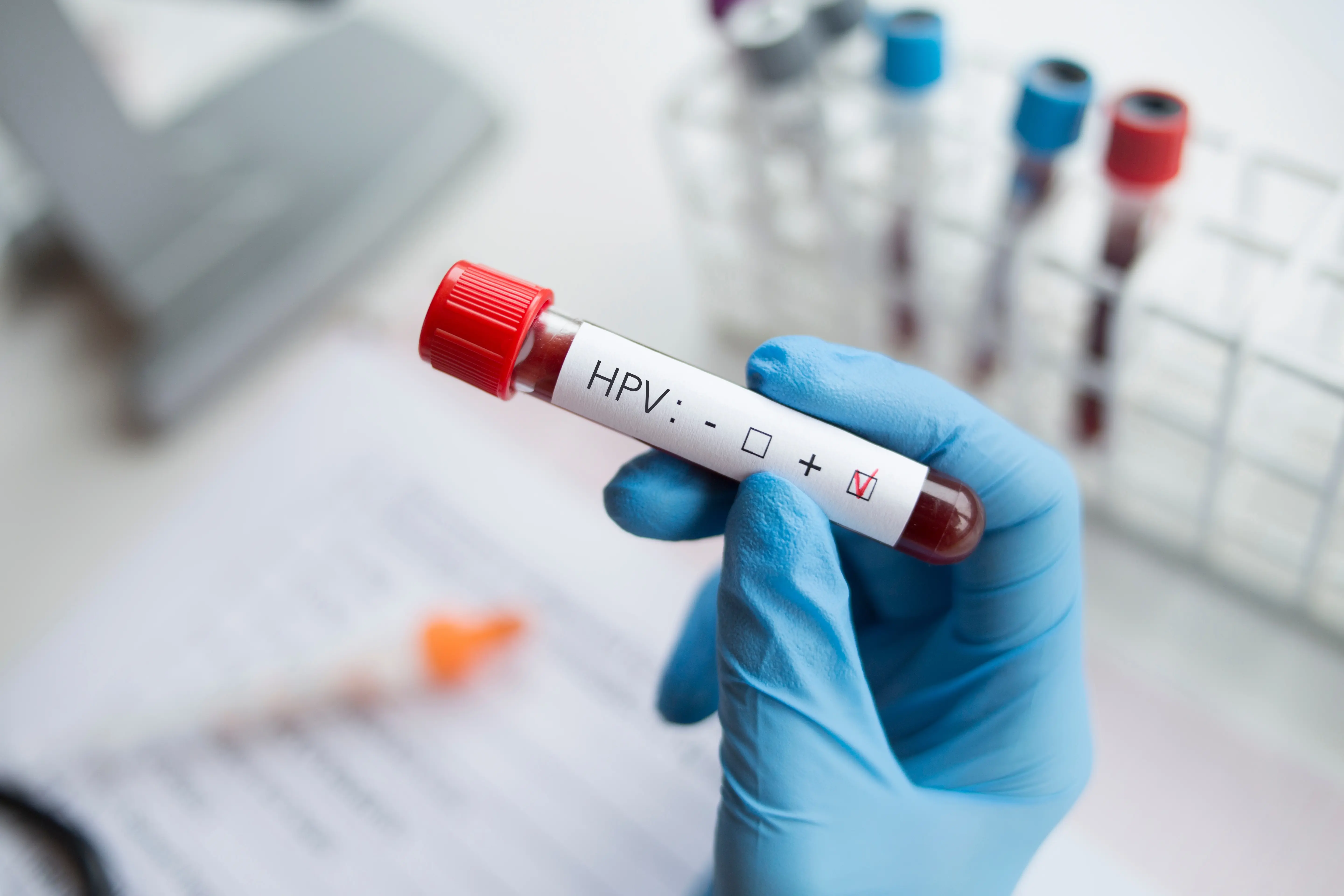 Laboratory,-,Blood,Sample,Positive,With,Hpv,(human,Papilloma,Virus)
